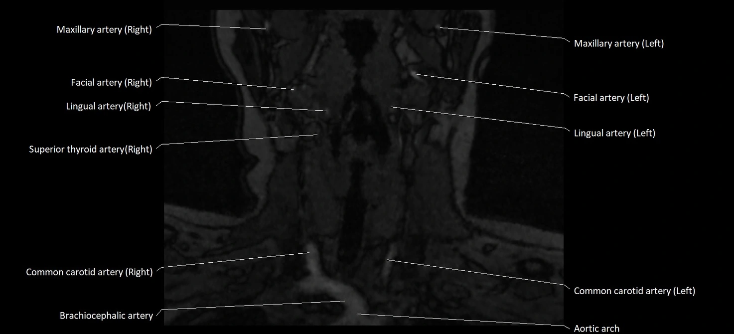 MRA carotid artery anatomy cross sectional 3T coronal image 3.webp